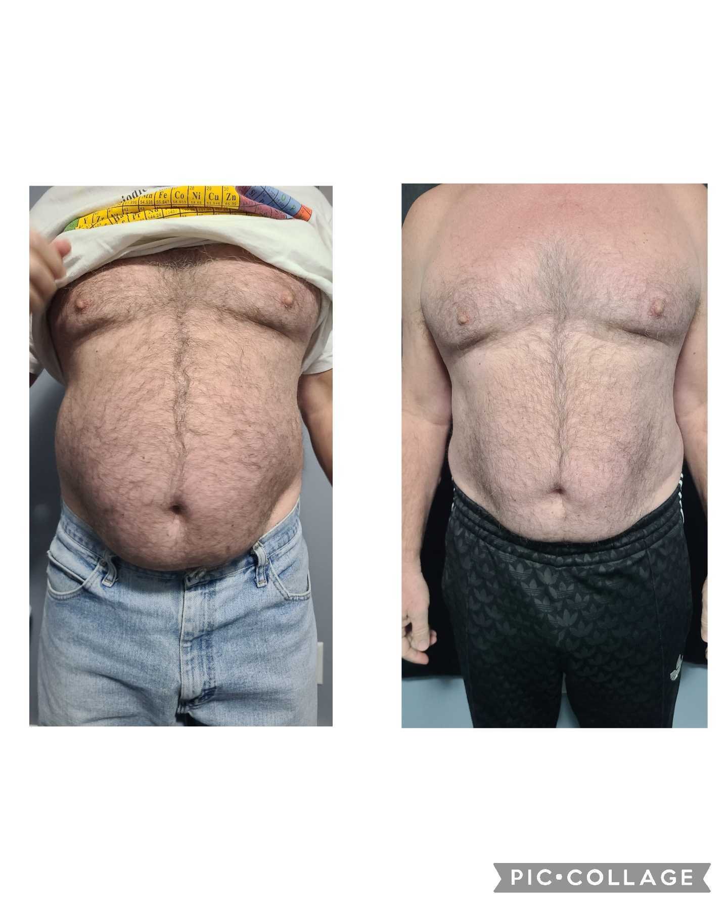 Emsculpt NEO Results 2