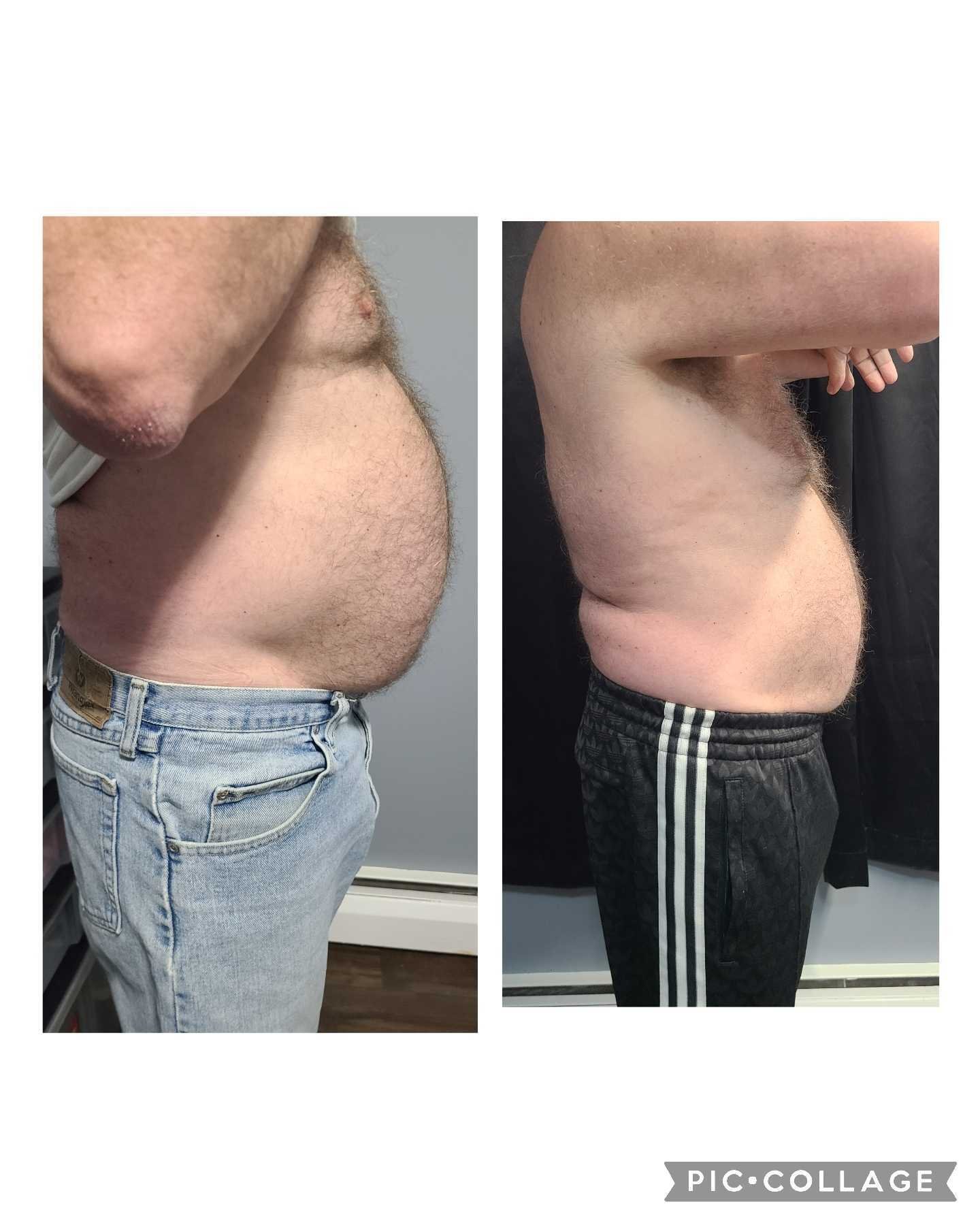 Emsculpt NEO Results 3