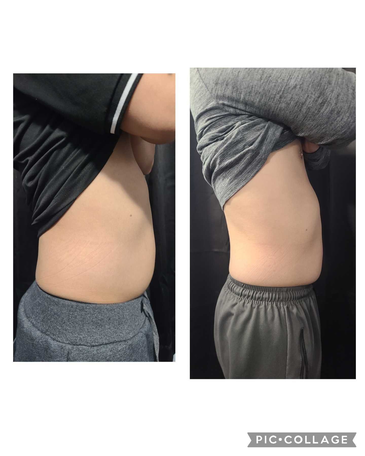 Emsculpt NEO Results 4