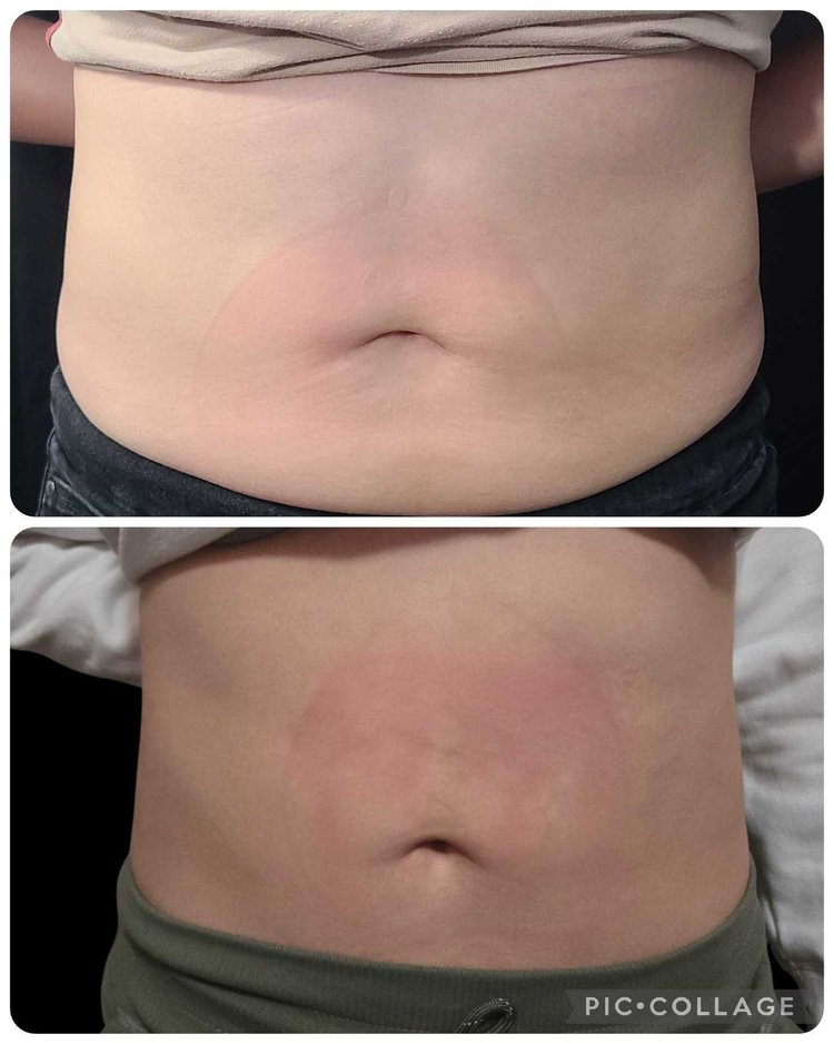 Emsculpt NEO Results 5