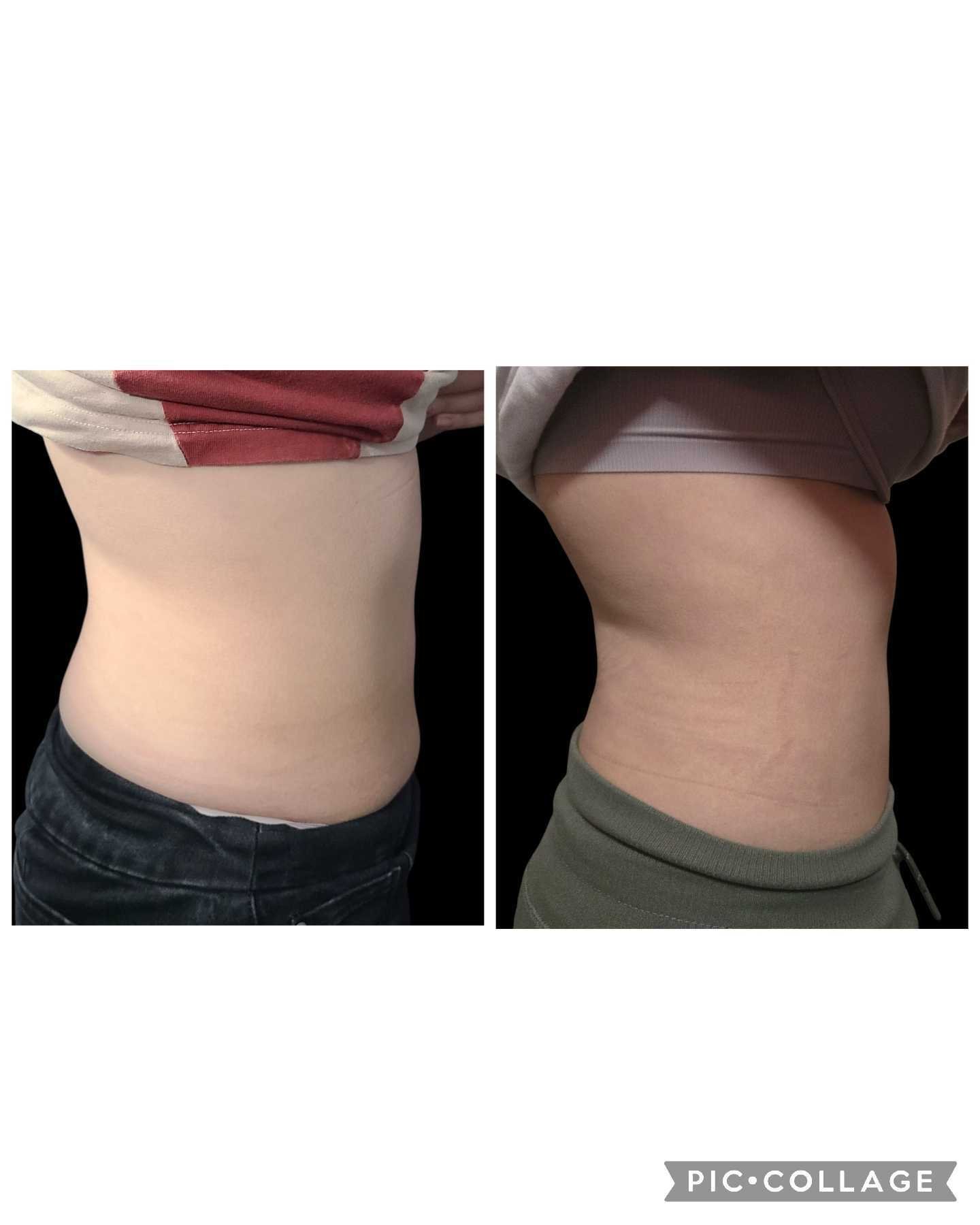 Emsculpt NEO Results 6